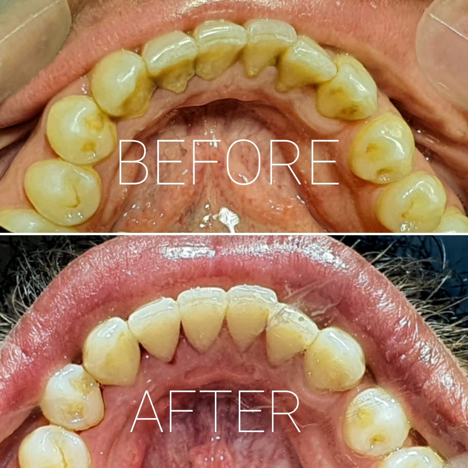 Scaling and Polishing Durrani’s Dental Clinic Dental Cleaning.