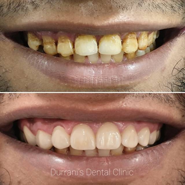 Dental Fillings - Durrani's Dental Clinic